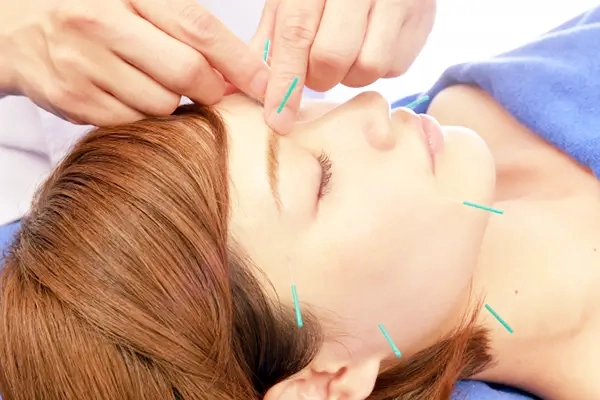 美容鍼について