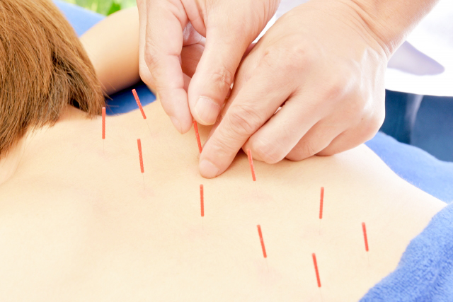 鍼灸について